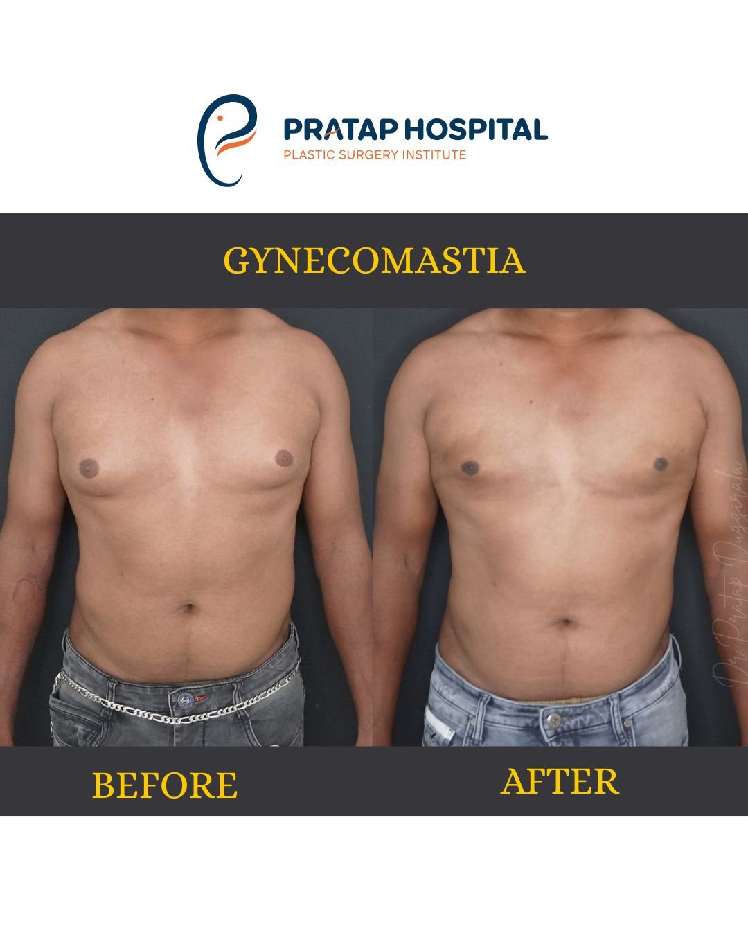 Gynecomastia Before