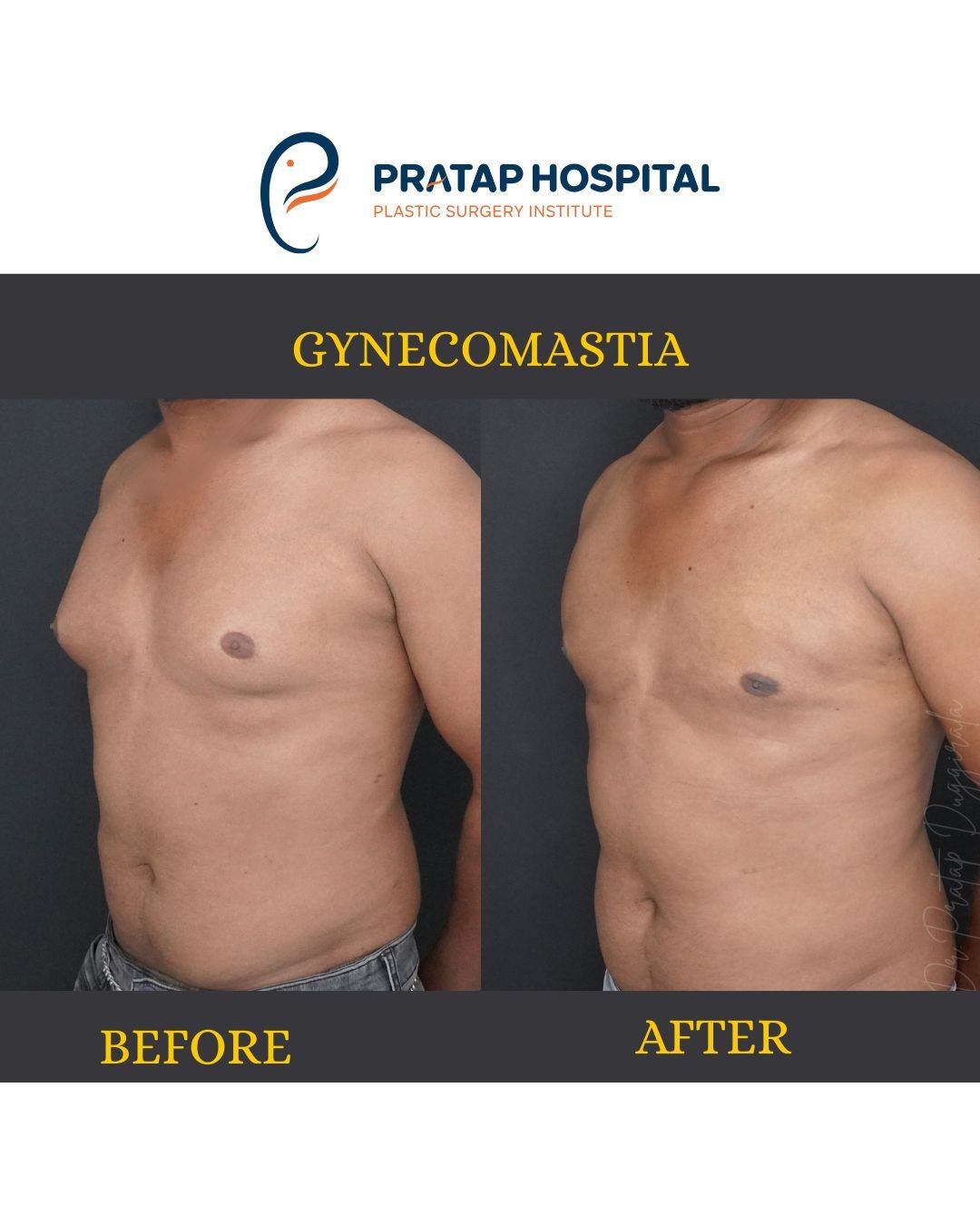 Gynecomastia After