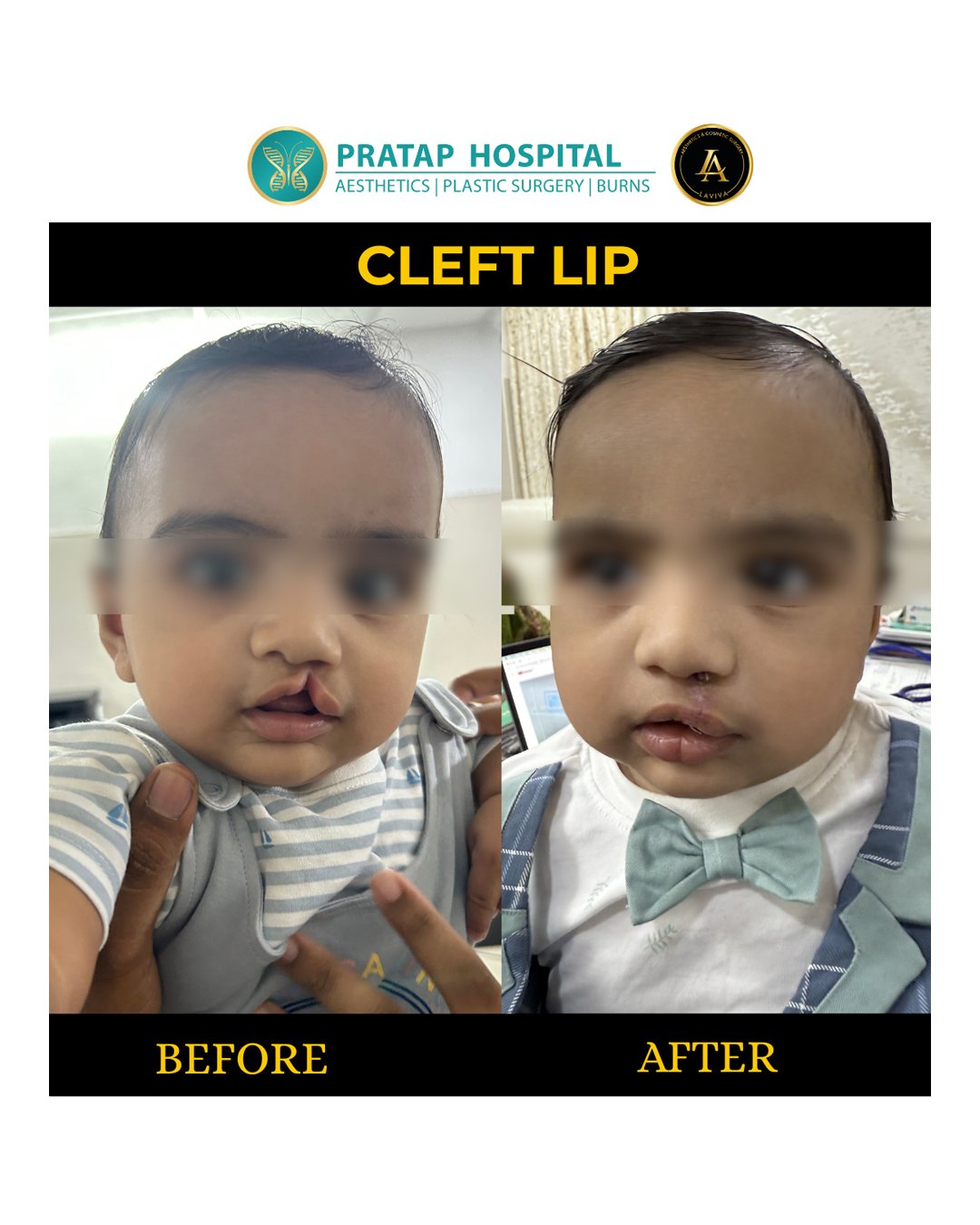 Gynecomastia After