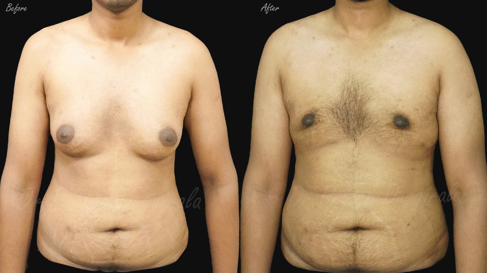 Before After Rhinoplasty